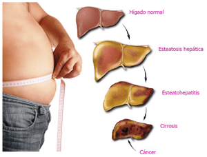 Liver Balance plus, para padecimientos del higado